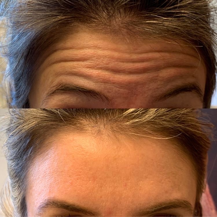Anti-Wrinkle Injections result — Forehead Lines
