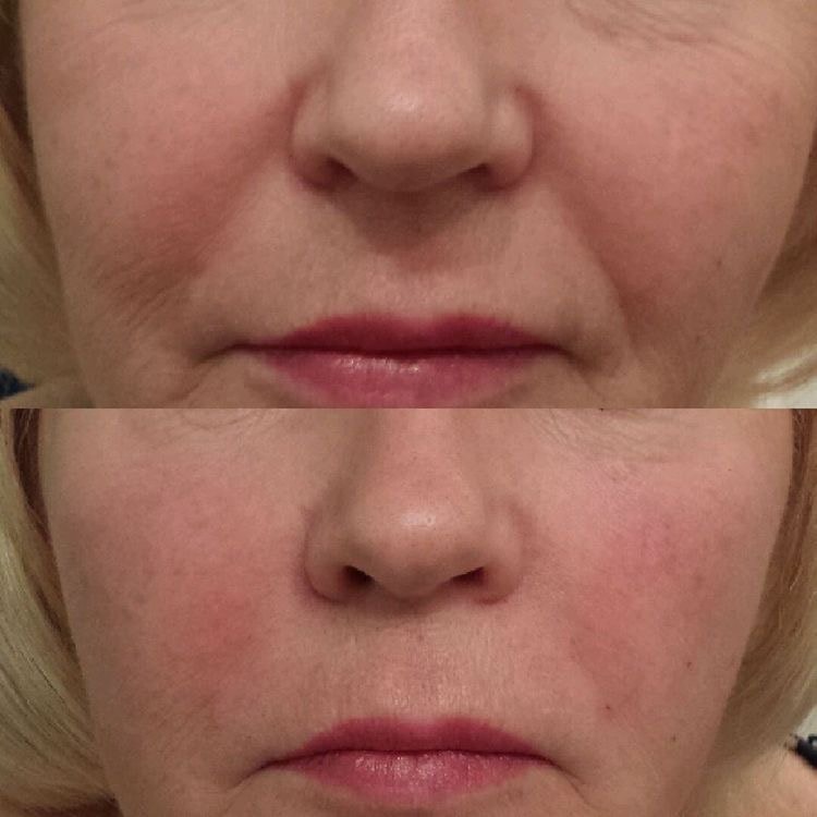 Dermal Fillers result — Nasolabial Folds