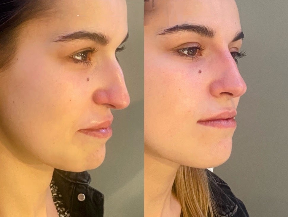 Dermal Fillers result — Nose Filler (Non-Surgical Rhinoplasty)