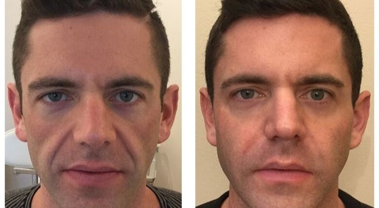 Dermal Fillers
